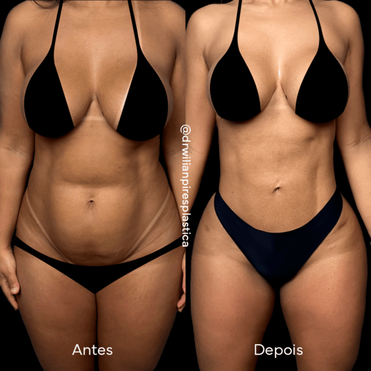 Antes e depois de Lipo HD, vista frontal