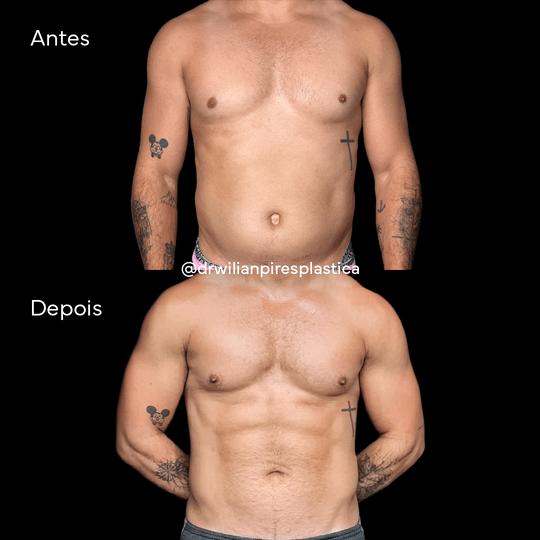 Antes e depois de Lipo HD em outra paciente