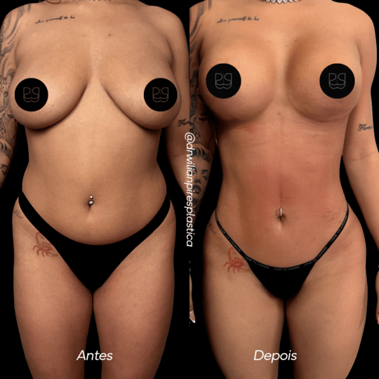 Antes e depois de lipo com mastopexia