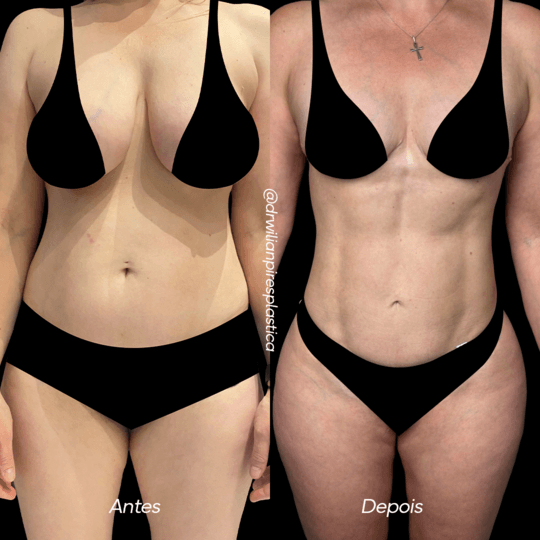 Antes e depois de lipo com mastopexia em outra paciente
