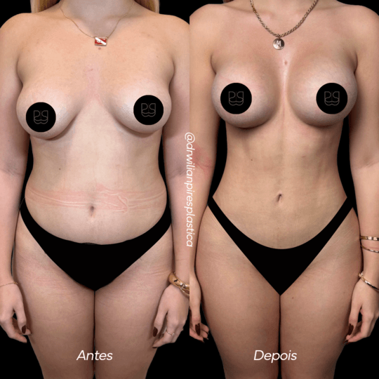 Antes e depois de lipo com silicone