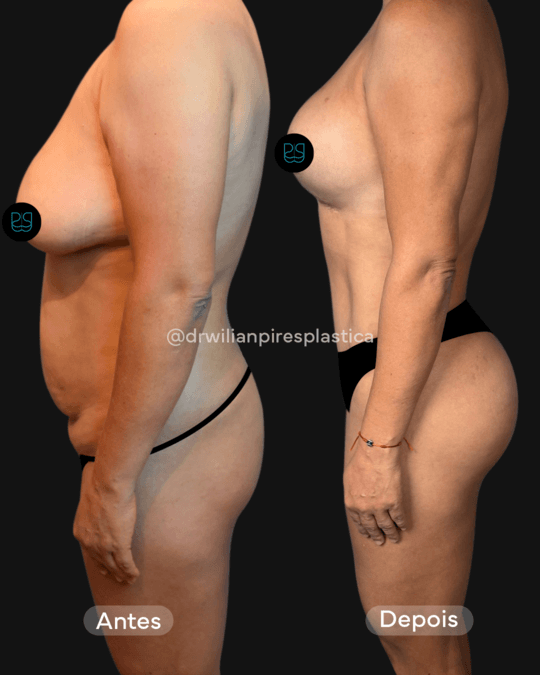 Antes e depois de mastopexia com abdominoplastia, vista de perfil