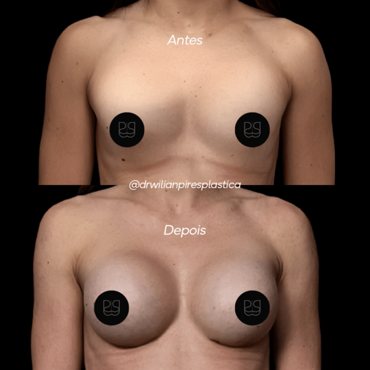 Antes e depois de Silicone Fast